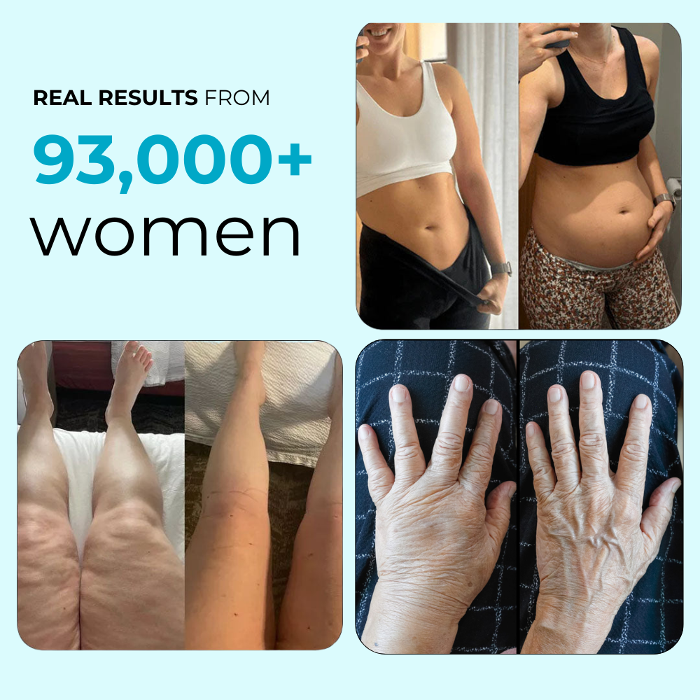 Anti-Cellulite & Lipedema Capsules by Auralea™